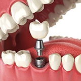 Dental implant in someone’s mouth