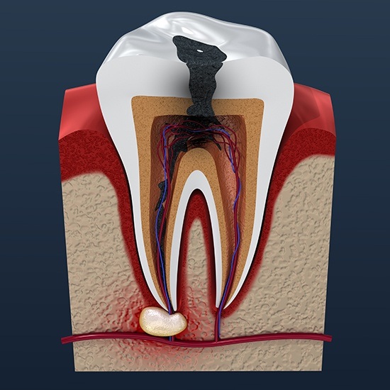 Computer illustration of tooth in need of root canal