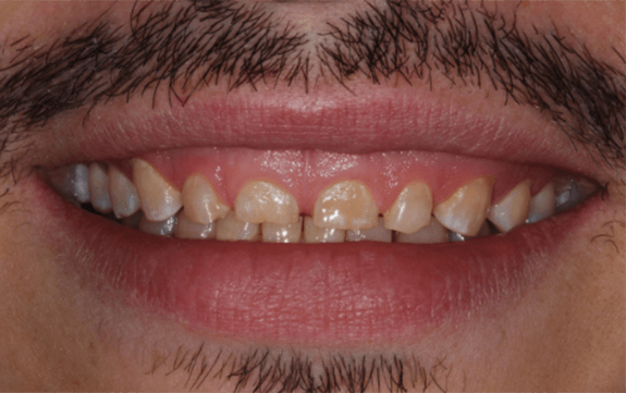 Severely worn and decayed teeth before dental care