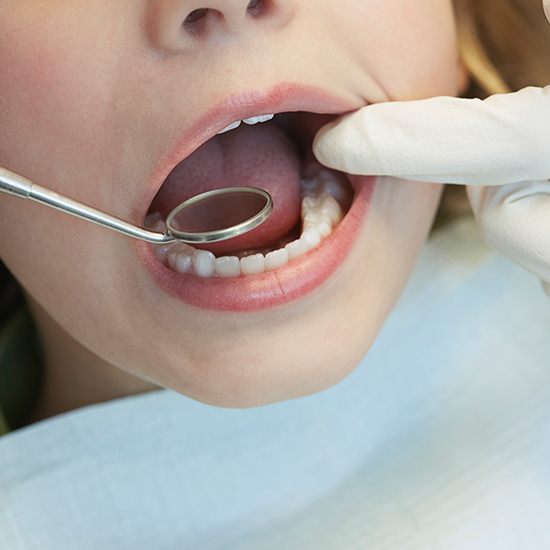 Child having smile checked after tooth colored filling restoration