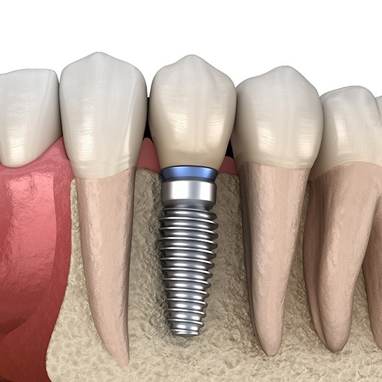 Computer illustraion of dental implant tooth replacement