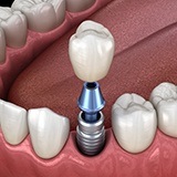Single dental implant supported dental crown