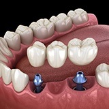 Multiple dental implant supported fixed bridge