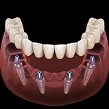 Dental implant supported denture