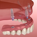 Computer illustration of All on four dental implant denture