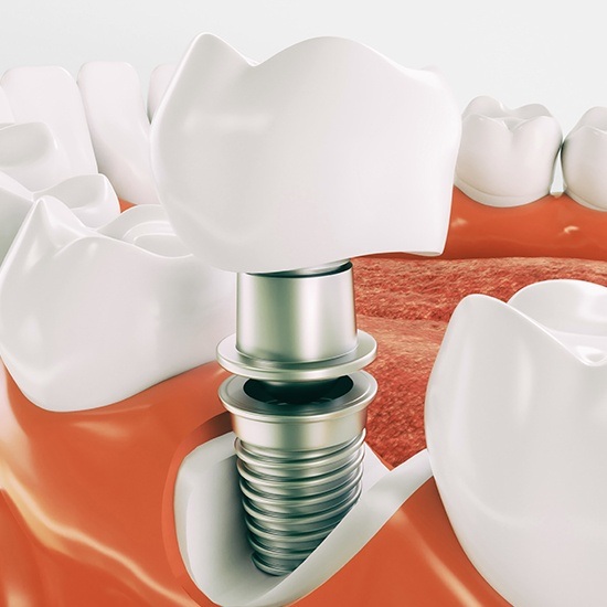 Computer illustration close up of dental implant