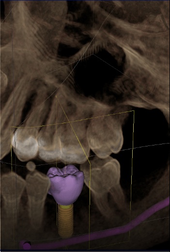 x-ray with purple tooth