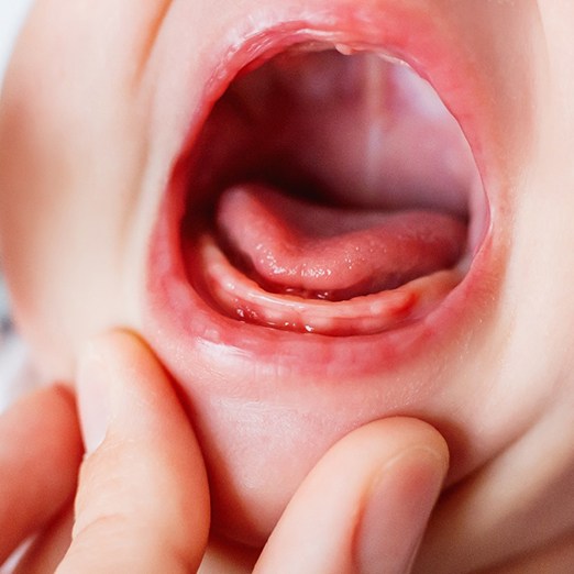 baby in need of a frenectomy for a tongue tie