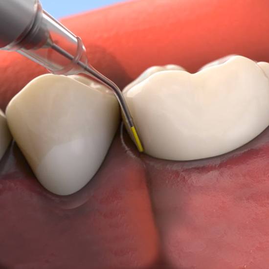 Computer illustration of antibotic therapy for gum disease