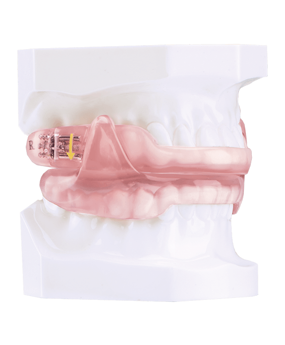 Sleep apnea oral appliance of smile model