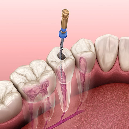 Computer illustration of root canal