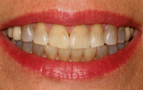 Severely yellowed top and bottom teeth before teeth whitening