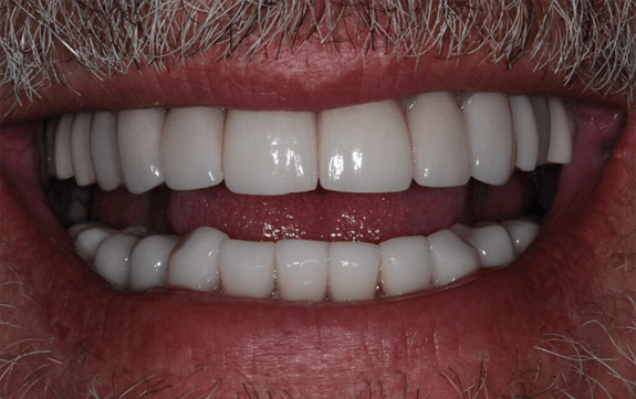 Brilliant healthy smile after cosmetic dentistry