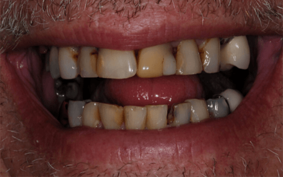 Severely decayed and damaged teeth before cosmetic dentistry