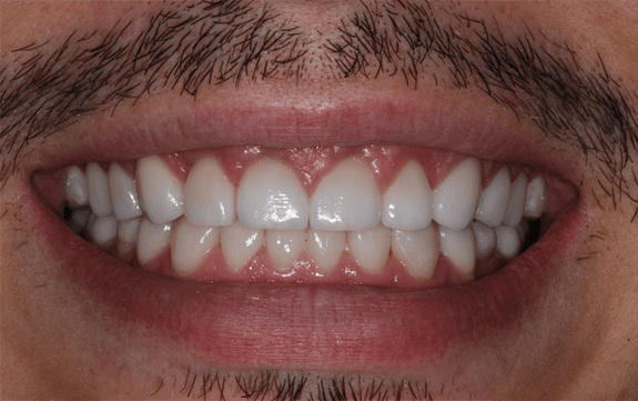 Fully restored smilea fter dental care