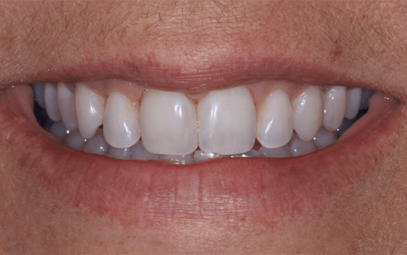 Perfectly aligned smile after cosmetic dentistry
