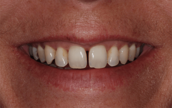 Gap between front teeth before cosmetic dentistry