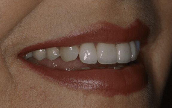 Patient with perfected smile after cosmetic dentistry
