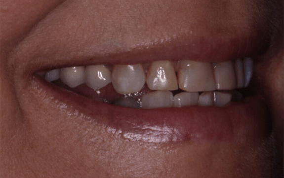 Patient with top tooth that is smaller than other teeth
