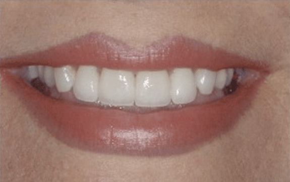 Bright white top front teeth after cosmetic dentistry