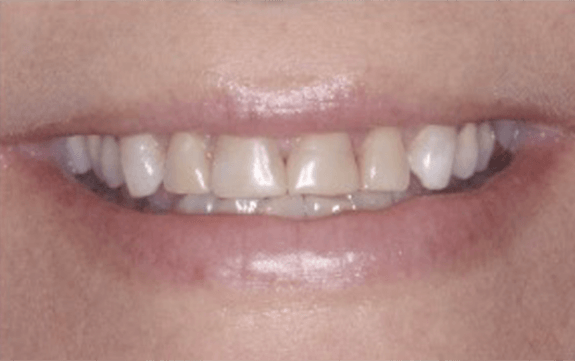 Discolored top front teeth before cosmetic dentstry