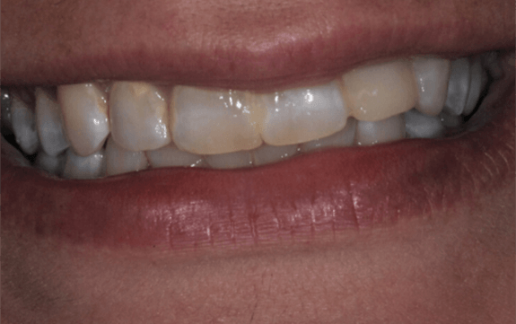 Smile with yellowing around the edges of teeth