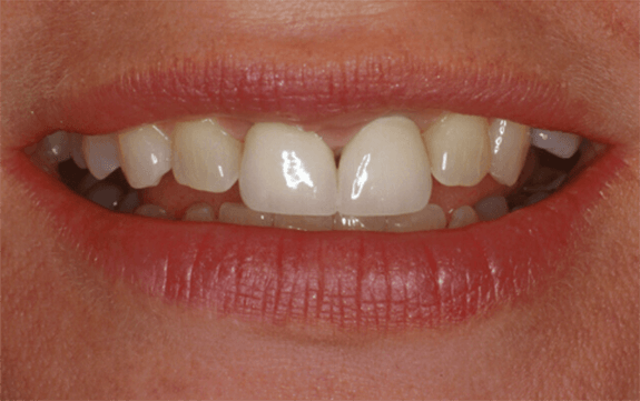 Discolored and worn teeth before cosmetic dentistry