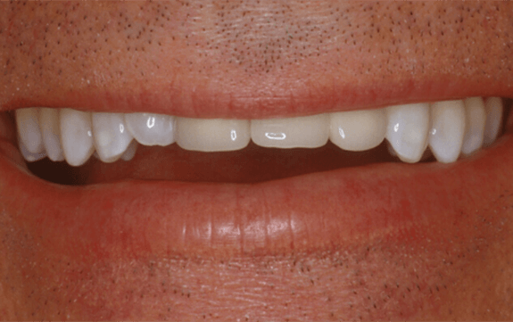 Front teeth shorter than surrounding teeth