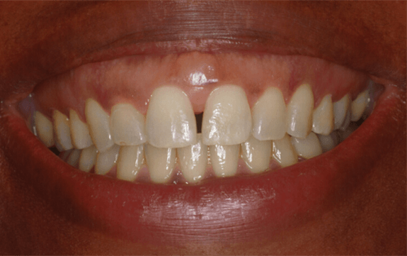 Gapped front teeth before cosmetic dentistry