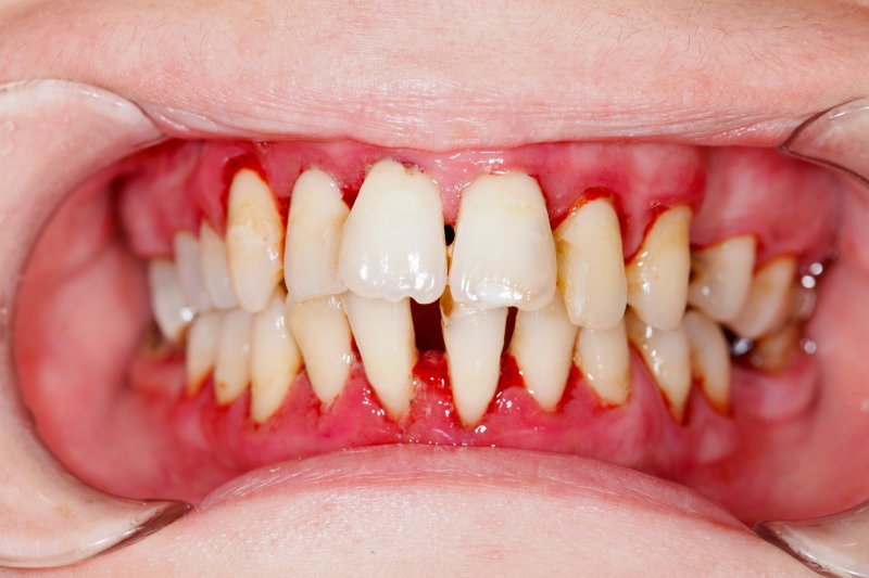 man showing teeth with receding gums